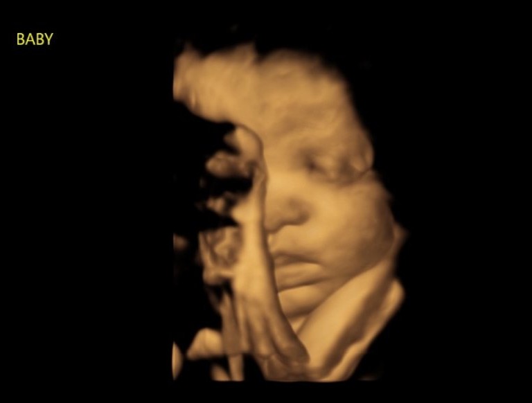 Saving generations, one ultrasound at a time