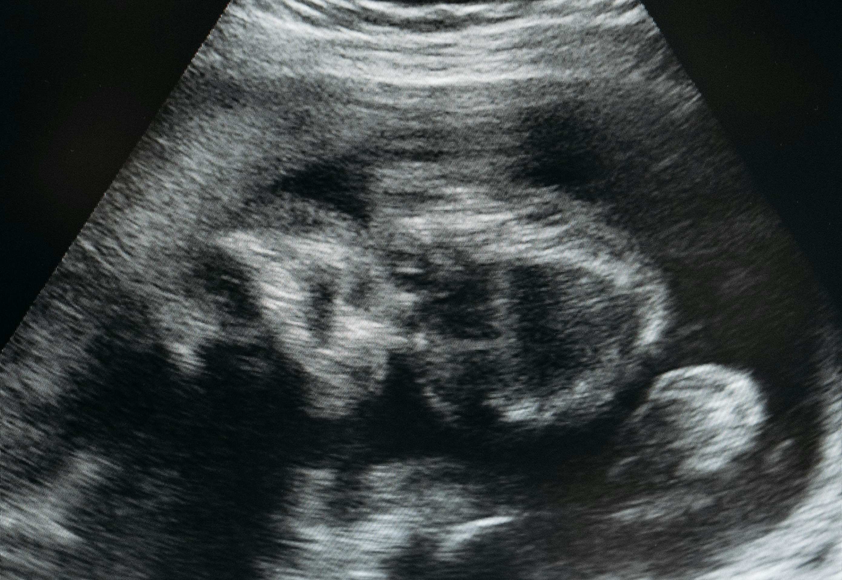 Bangladesh combats threat of selective abortions by banning disclosure of babies’ sex in the womb