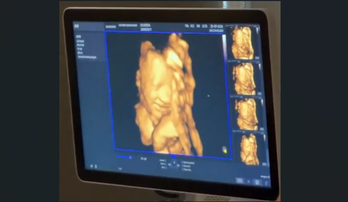 Caught on camera: Ultrasound captures unborn baby smiling as her father speaks