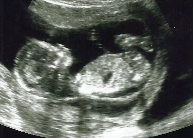 The question of when life begins is back in play