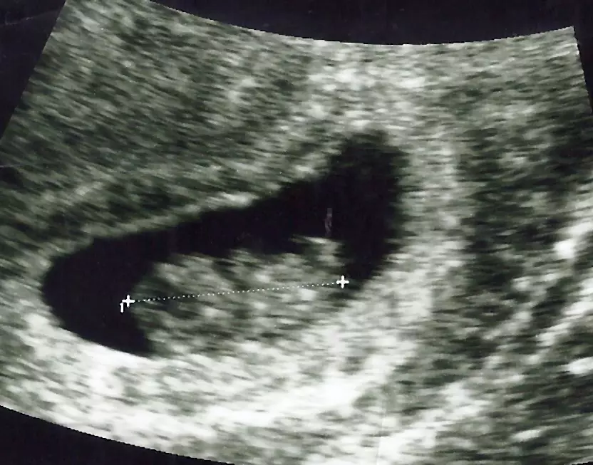 Abortion clinic dodges Ohio law, suggests mothers hide they’re aborting unborn baby because of Down syndrome