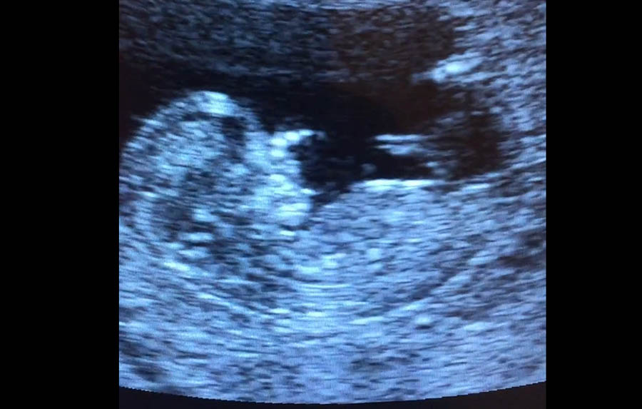 Planned Parenthood tries to say a fetal heartbeat only 'sounds like a heartbeat'