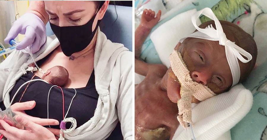Baby born at 22 weeks defies the odds to survive