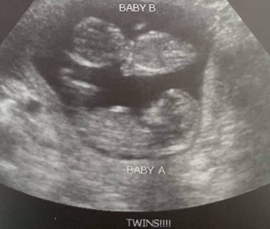 Healthy twins survive chemical abortion after Planned Parenthood failed to disclose second child in utero