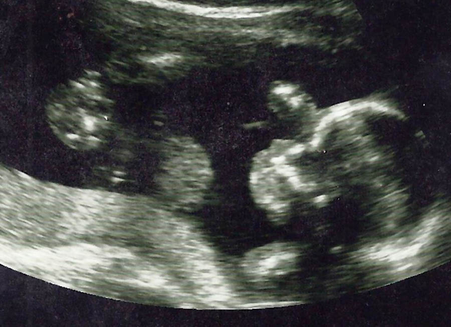 Judge blocks Iowa heartbeat law