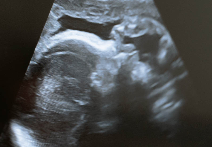 The case that could topple Roe - What you need to know